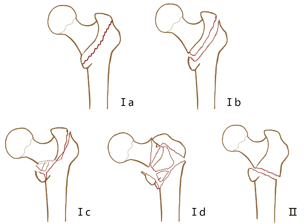 Evans classification Evans classification