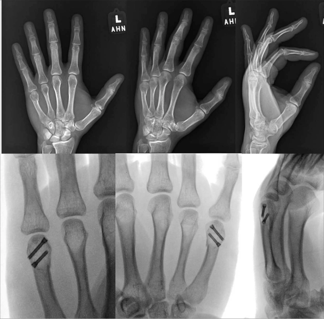 Fracture of the metacarpal head Fracture of the metacarpal head