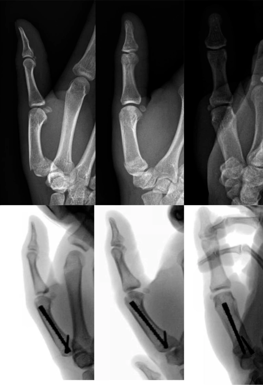 Metacarpal base fracture (1) Metacarpal base fracture (1)