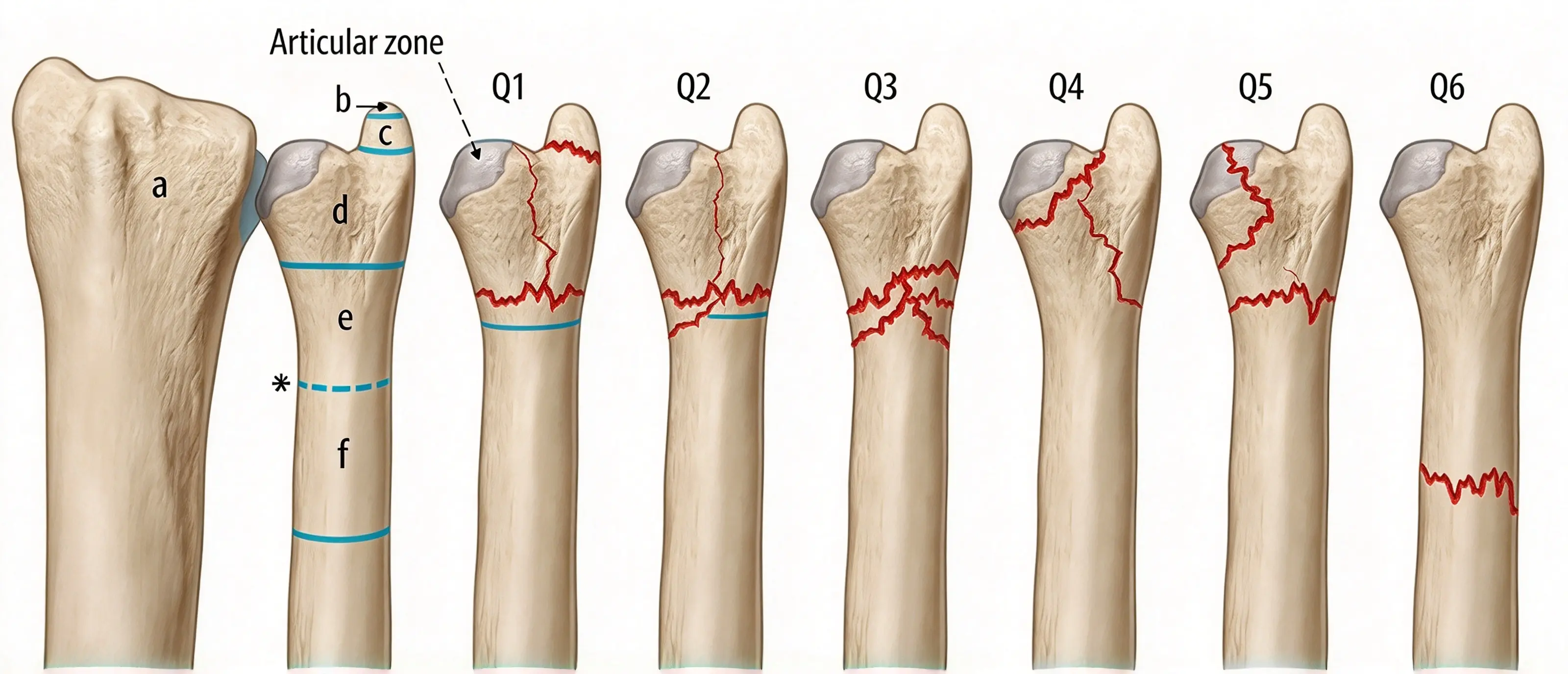 Regions of the distal ulna Regions of the distal ulna