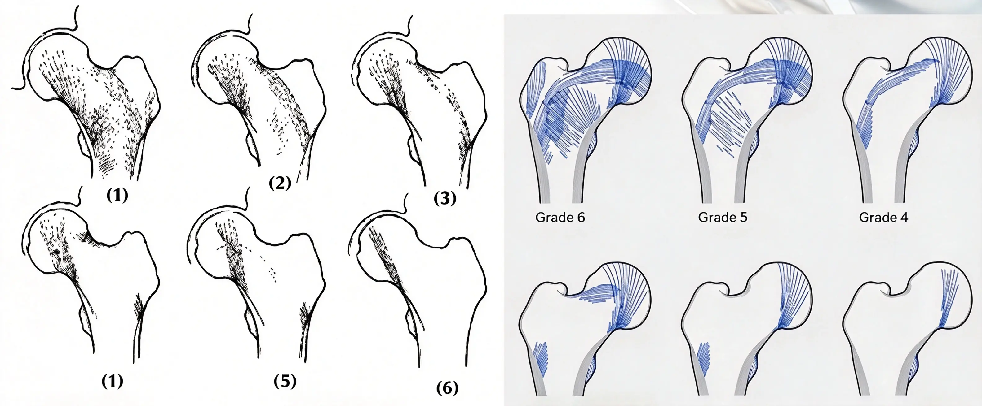 Femoral trabecular grading diagram (1) Femoral trabecular grading diagram (1)
