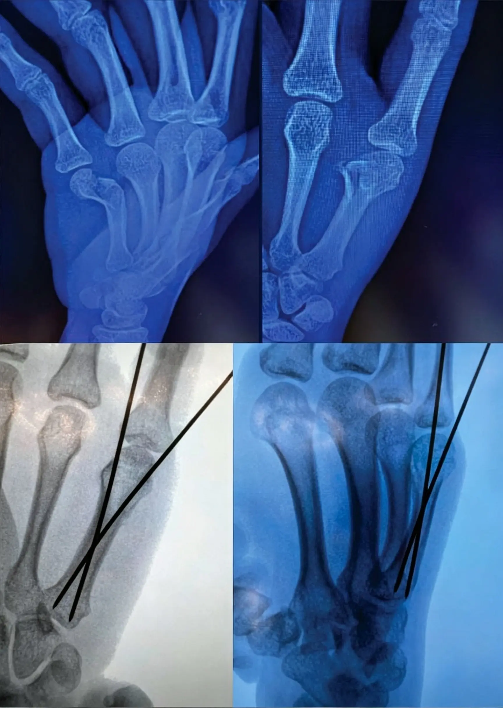 Metacarpal neck fracture (1) Metacarpal neck fracture (1)