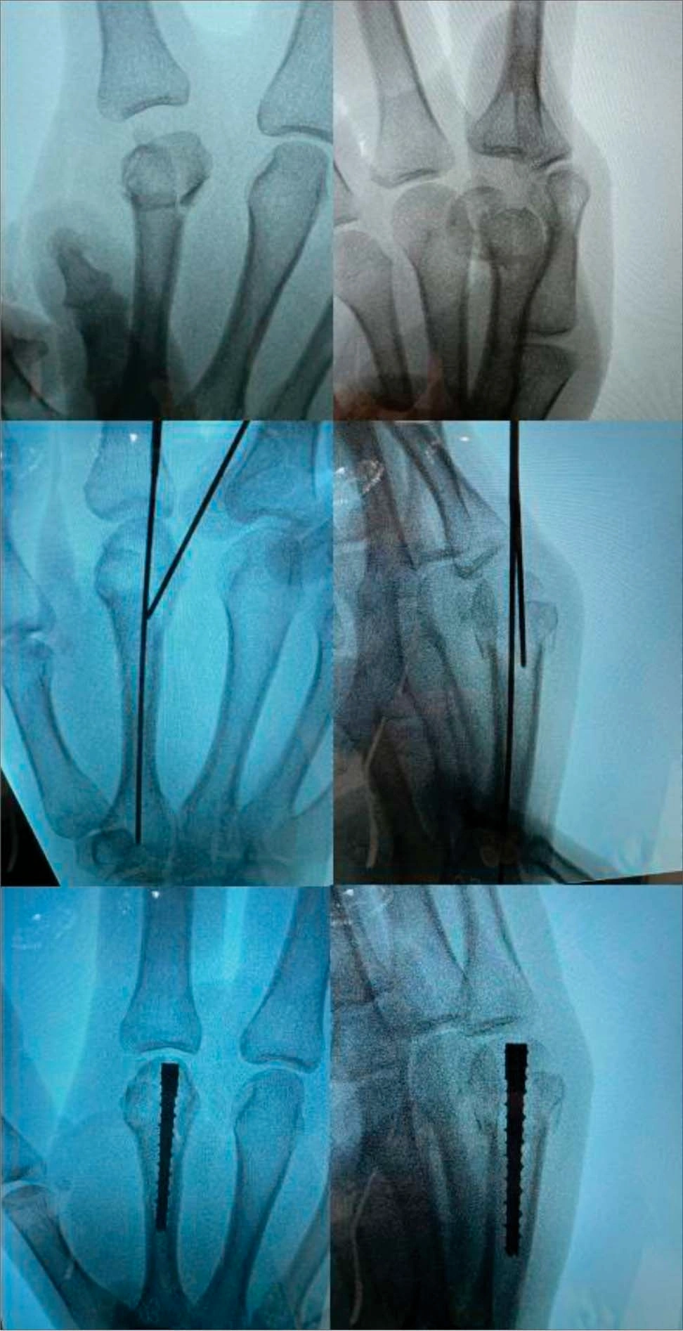 Fracture of the metacarpal head 1 Fracture of the metacarpal head 1