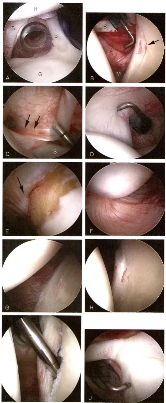 Diagnostic arthroscopy Diagnostic arthroscopy