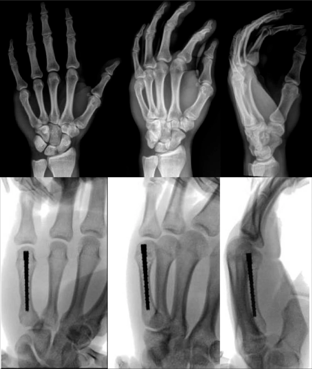 Metacarpal neck fracture 1 Metacarpal neck fracture 1