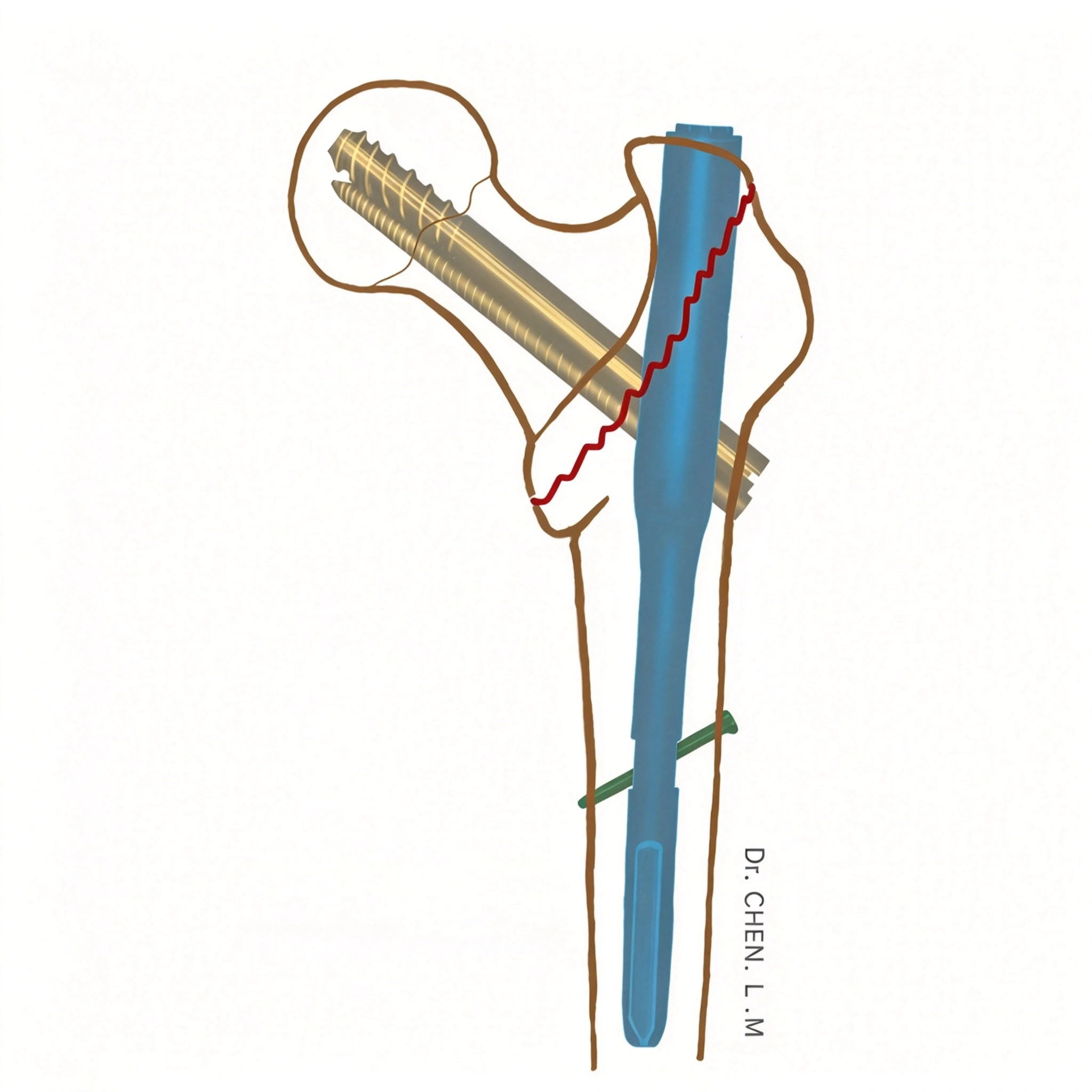 INTERTAN internal fixation INTERTAN internal fixation