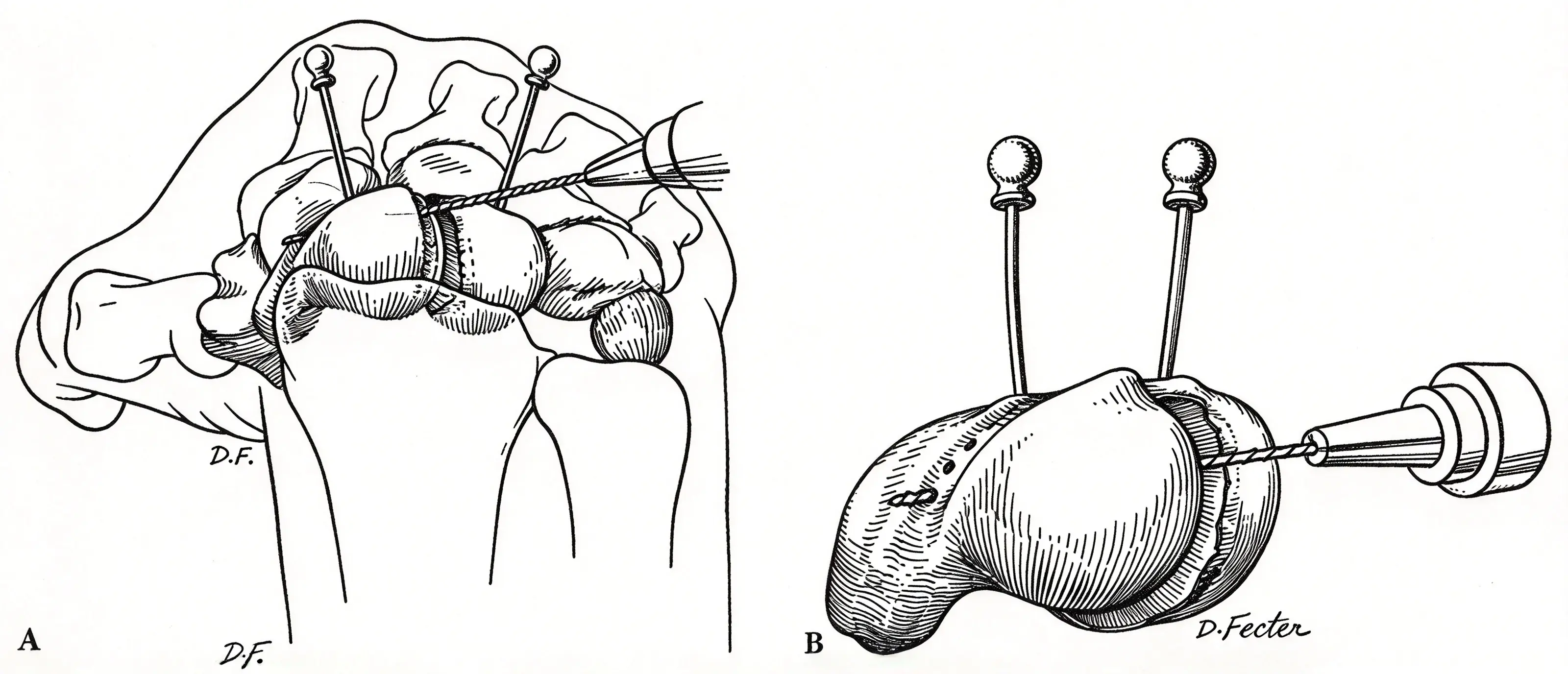 SL ligament (6) SL ligament (6)
