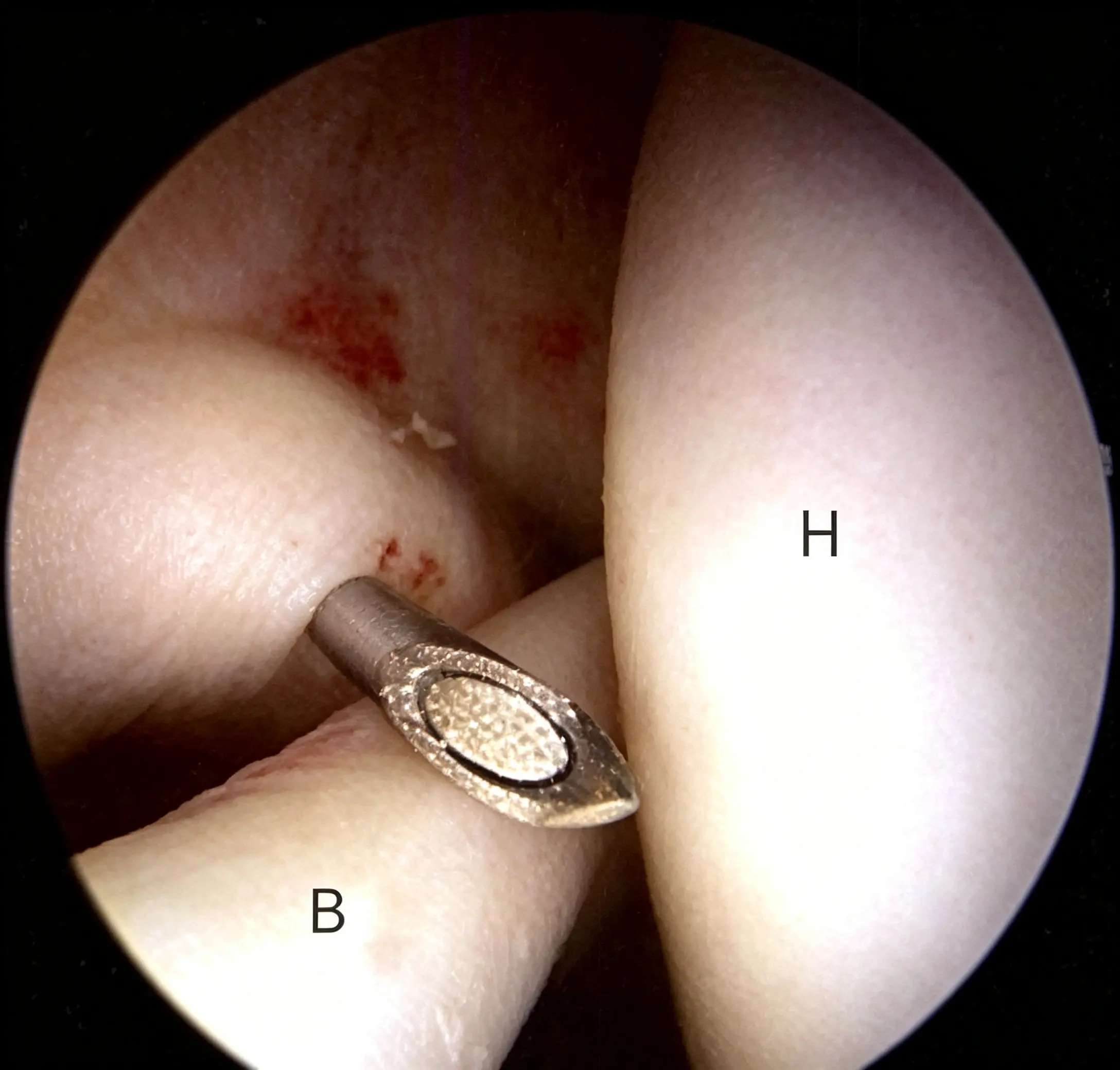 Humeral head and long head of the biceps tendon Humeral head and long head of the biceps tendon