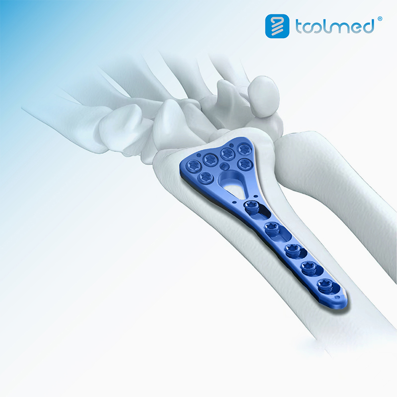 Locking-Plate-System