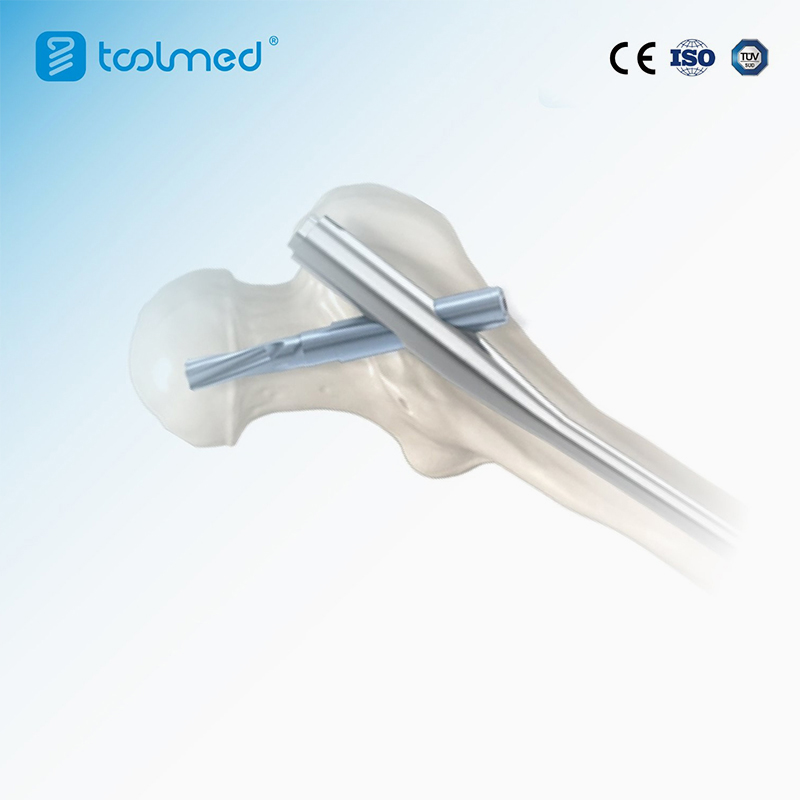 Intramedullary-Nail-System