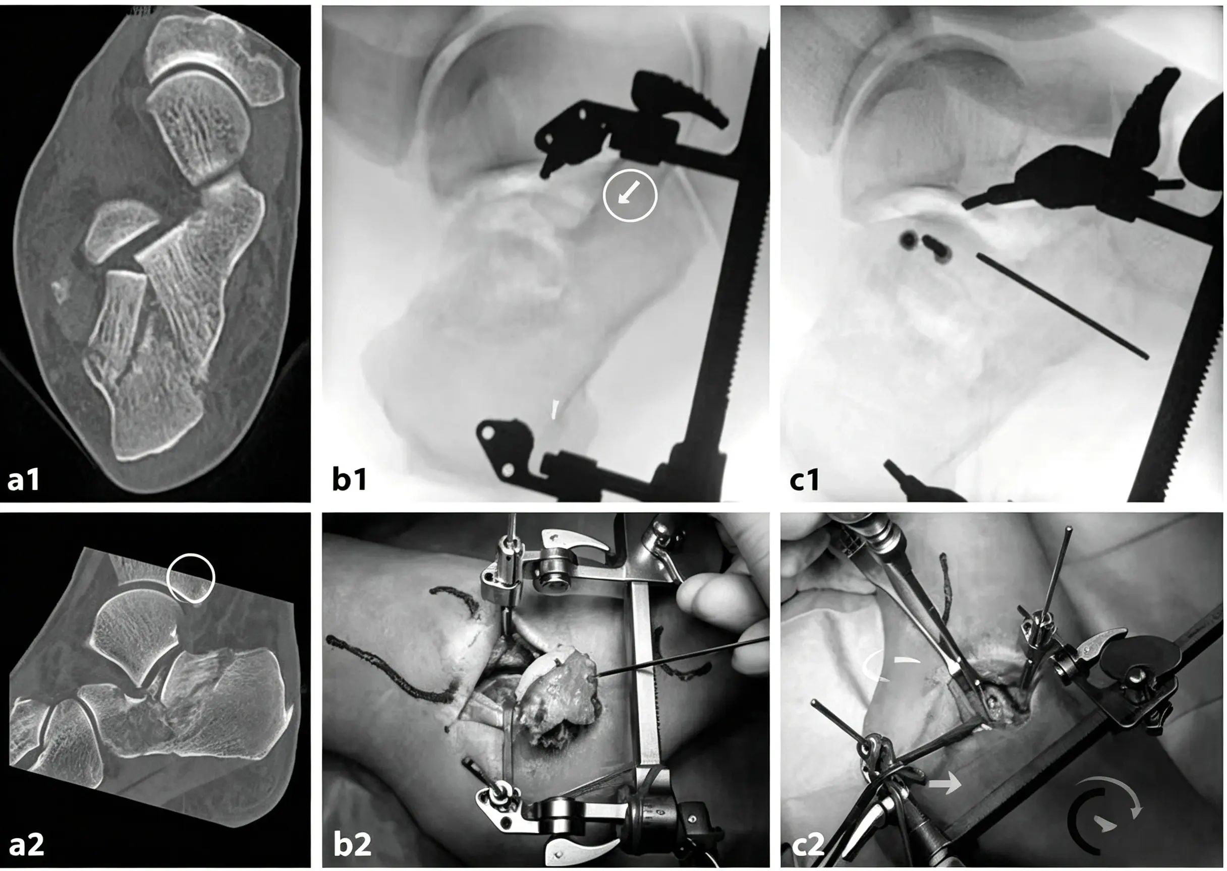 Sinus tarsi approach for the treatment of Sanders type IIA calcaneal fractures (1) (1)