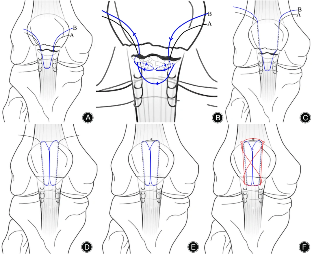 Krachow suture.webp