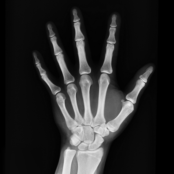 metacarpal bone.jpg