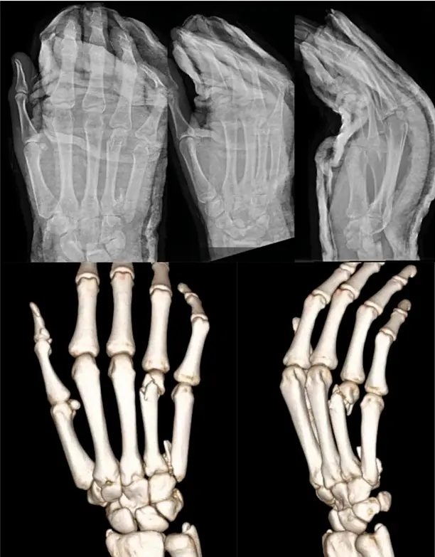 Percutaneous K-Wire Fixation (1).webp