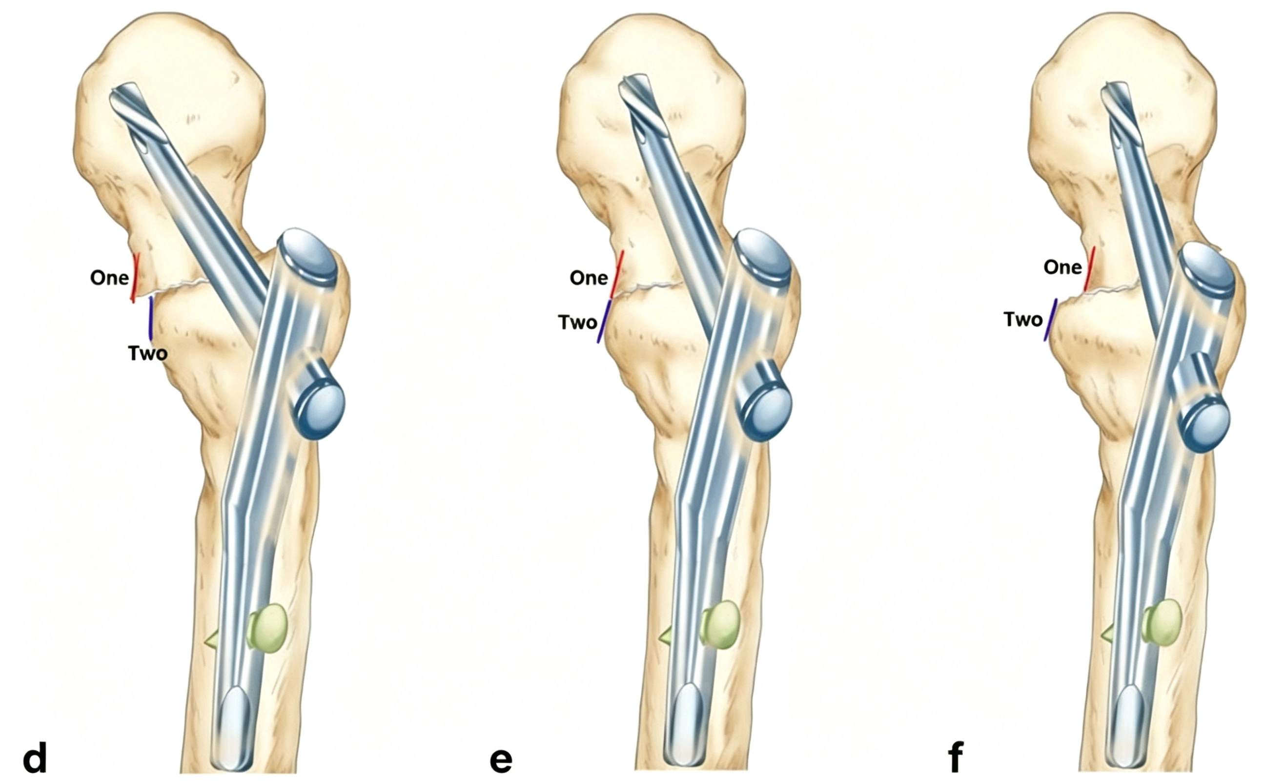 Lateral view of the hip fracture
