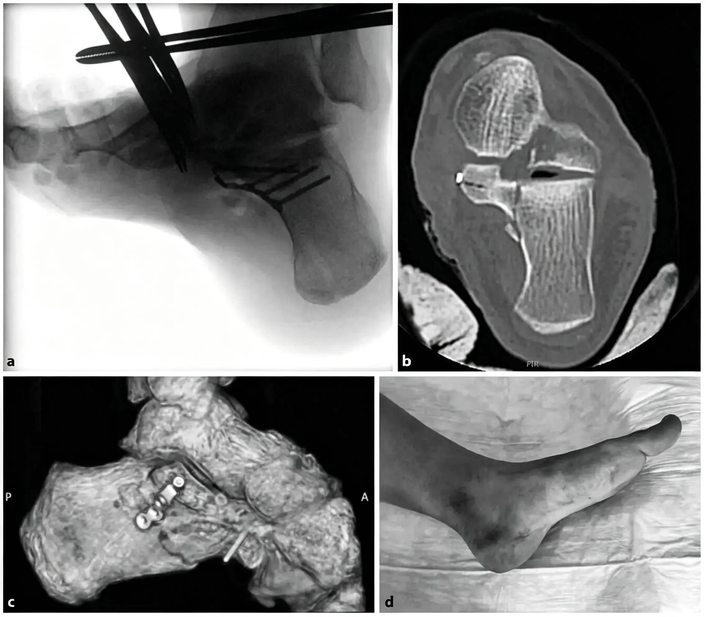 Medial approach (1) (1)