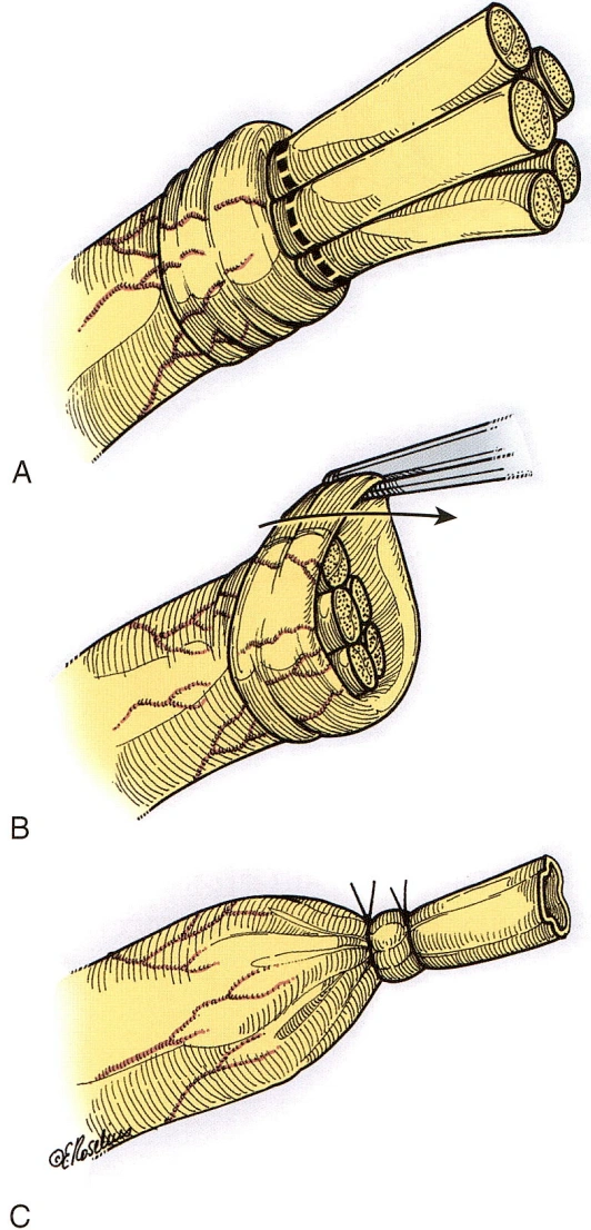 Treatment of painful neuroma