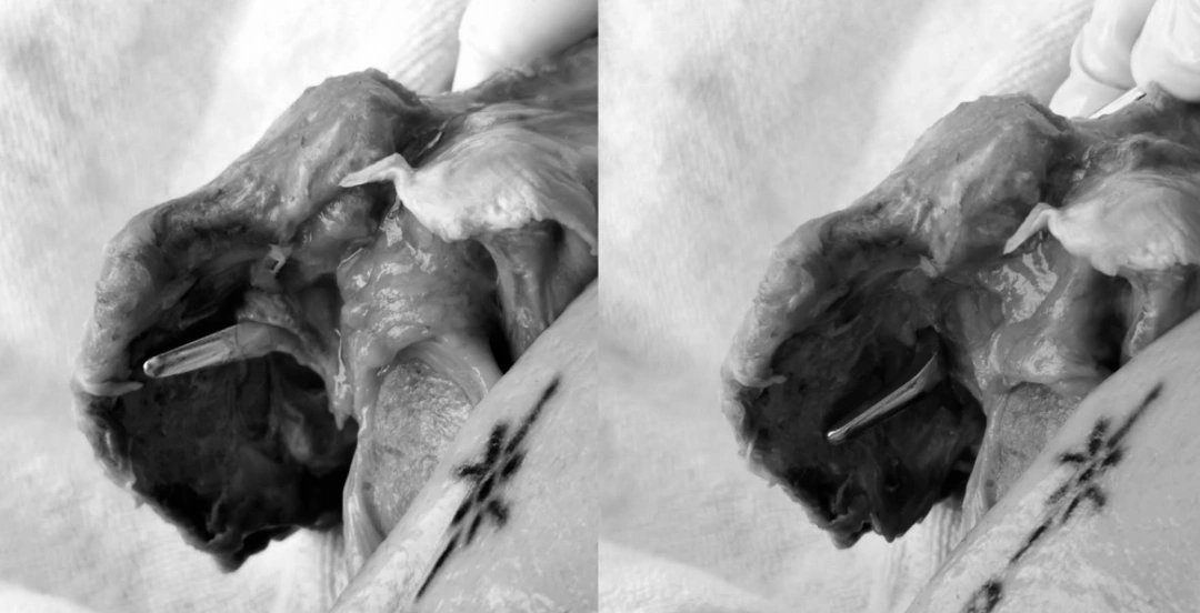 The position of the hook when placed at different angles beneath the acromion.webp