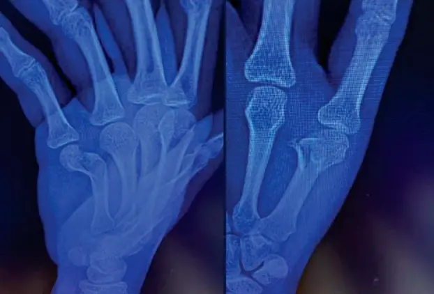 Percutaneous K-Wire Fixation (1).webp