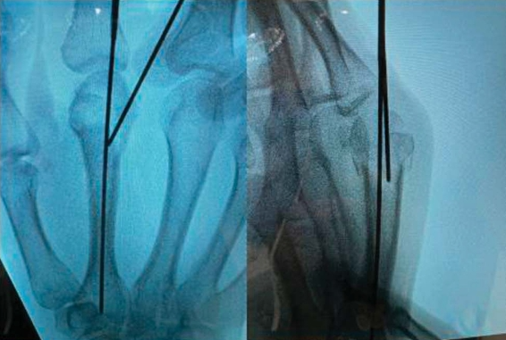 Intramedullary Screw Fixation 2.png