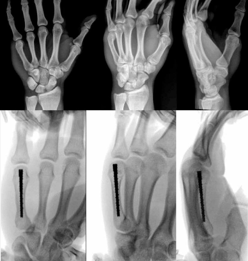 Intramedullary Screw Fixation.webp
