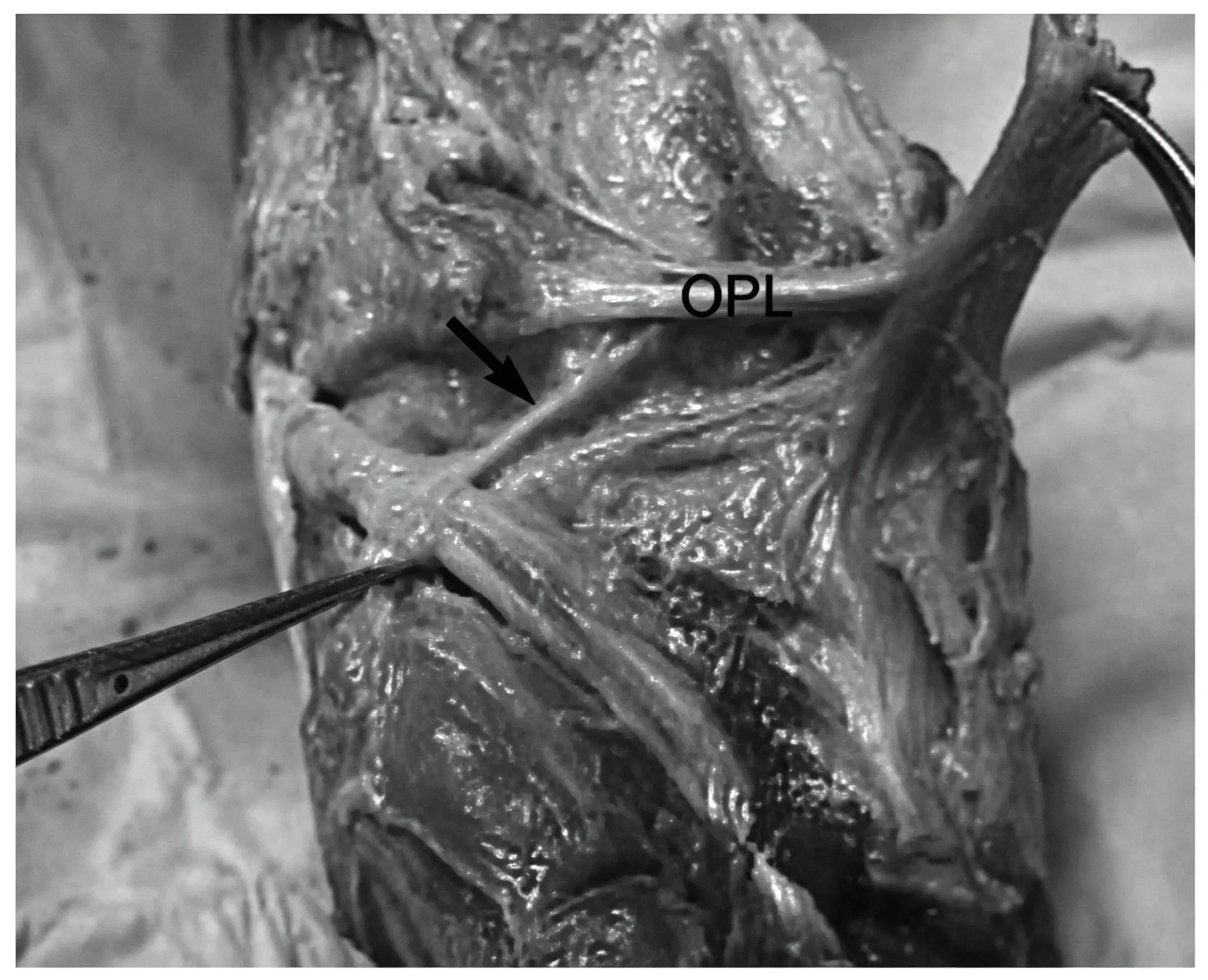 Figure 4. Posterior view of the left knee joint..webp