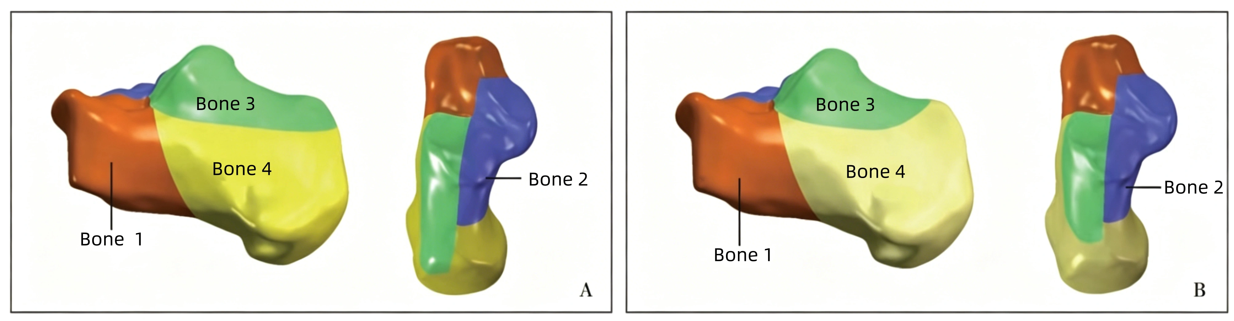 Calcaneal fracture model.webp