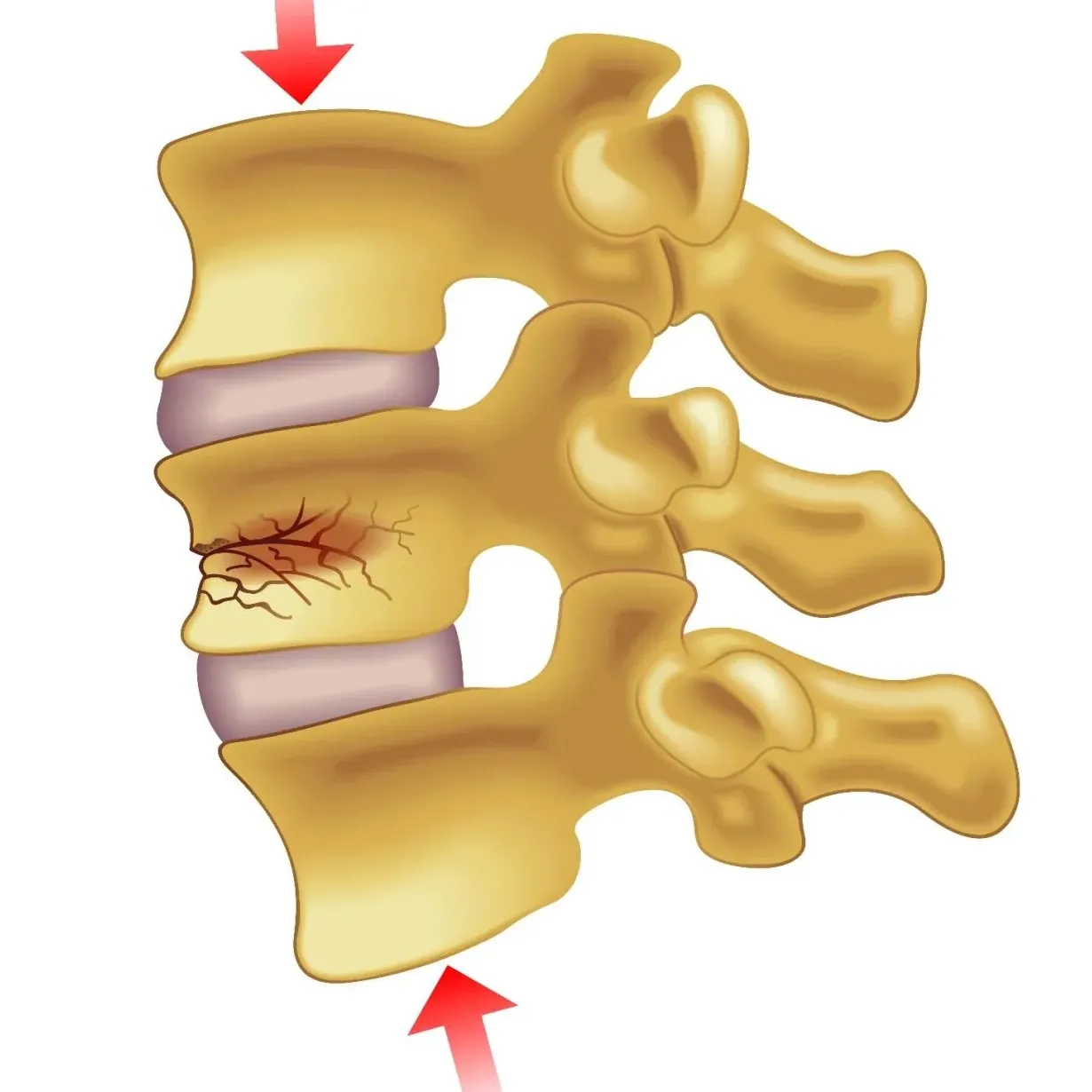Vertebral fracture_1230_1230.webp