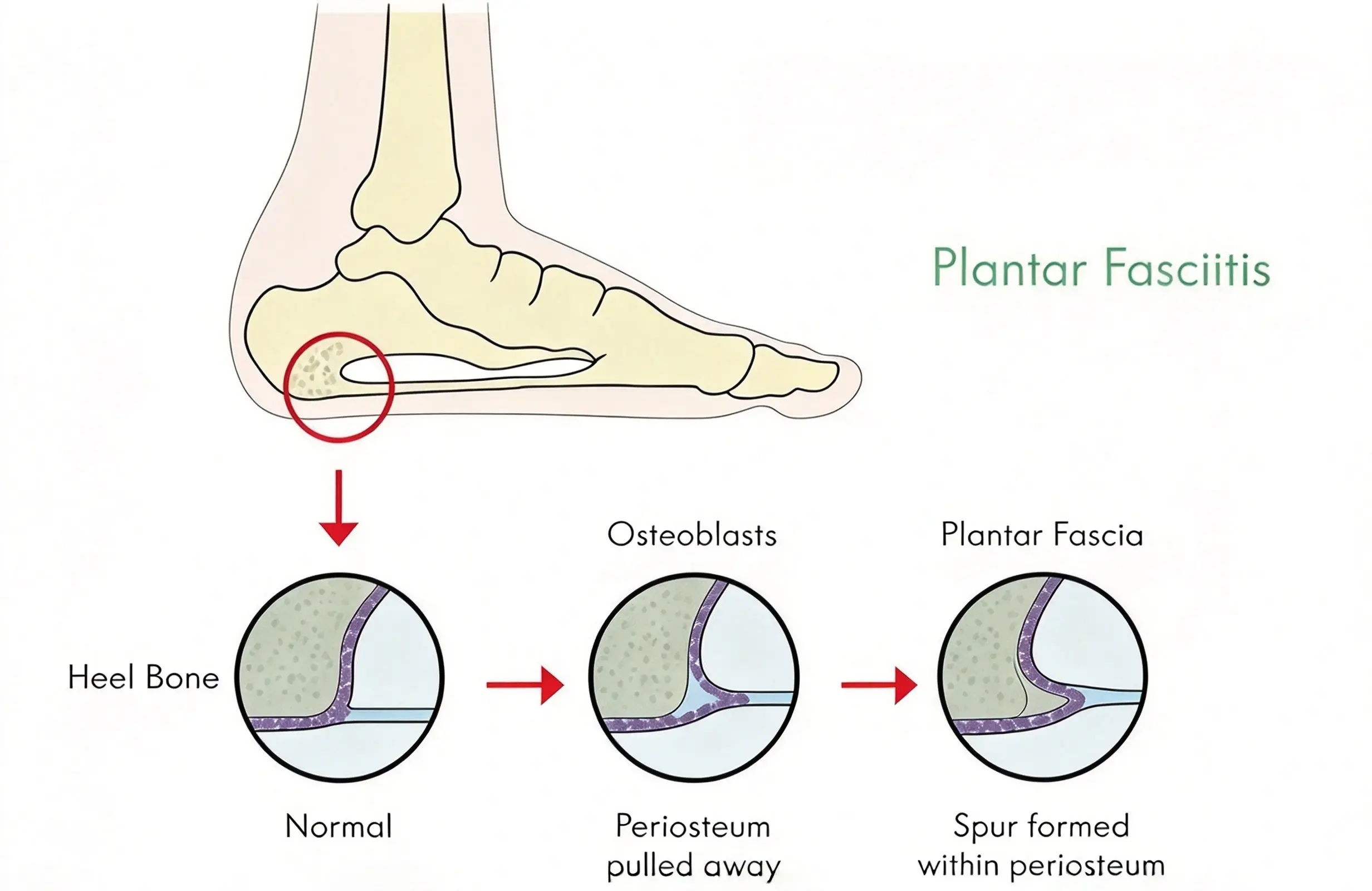 Plantar Fasciitis (1) (1)