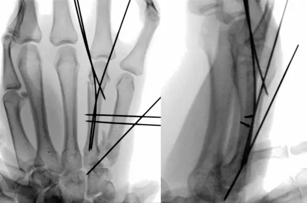 Percutaneous K-Wire Fixation2 (1).webp