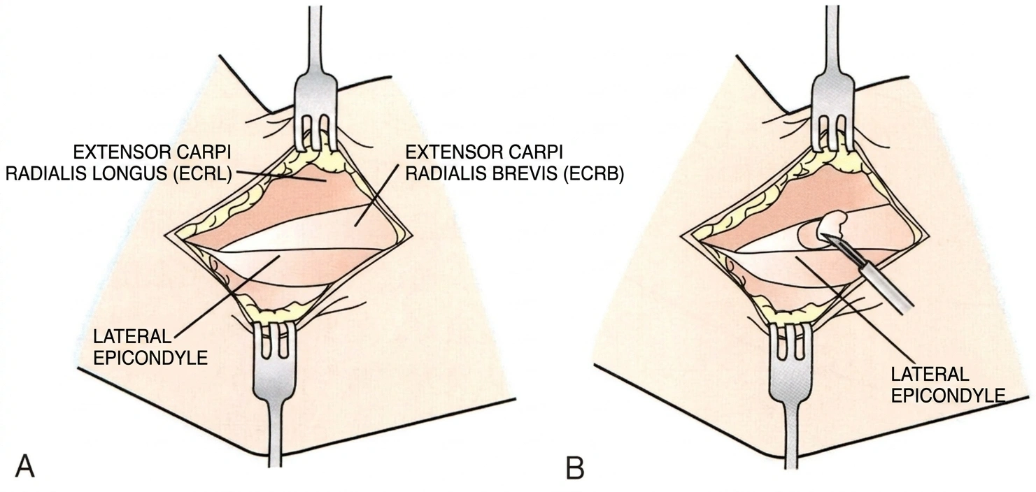 Skin Incision.webp
