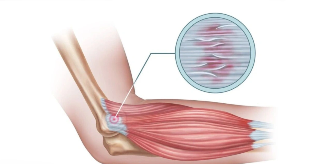 Lateral Epicondylitis.webp