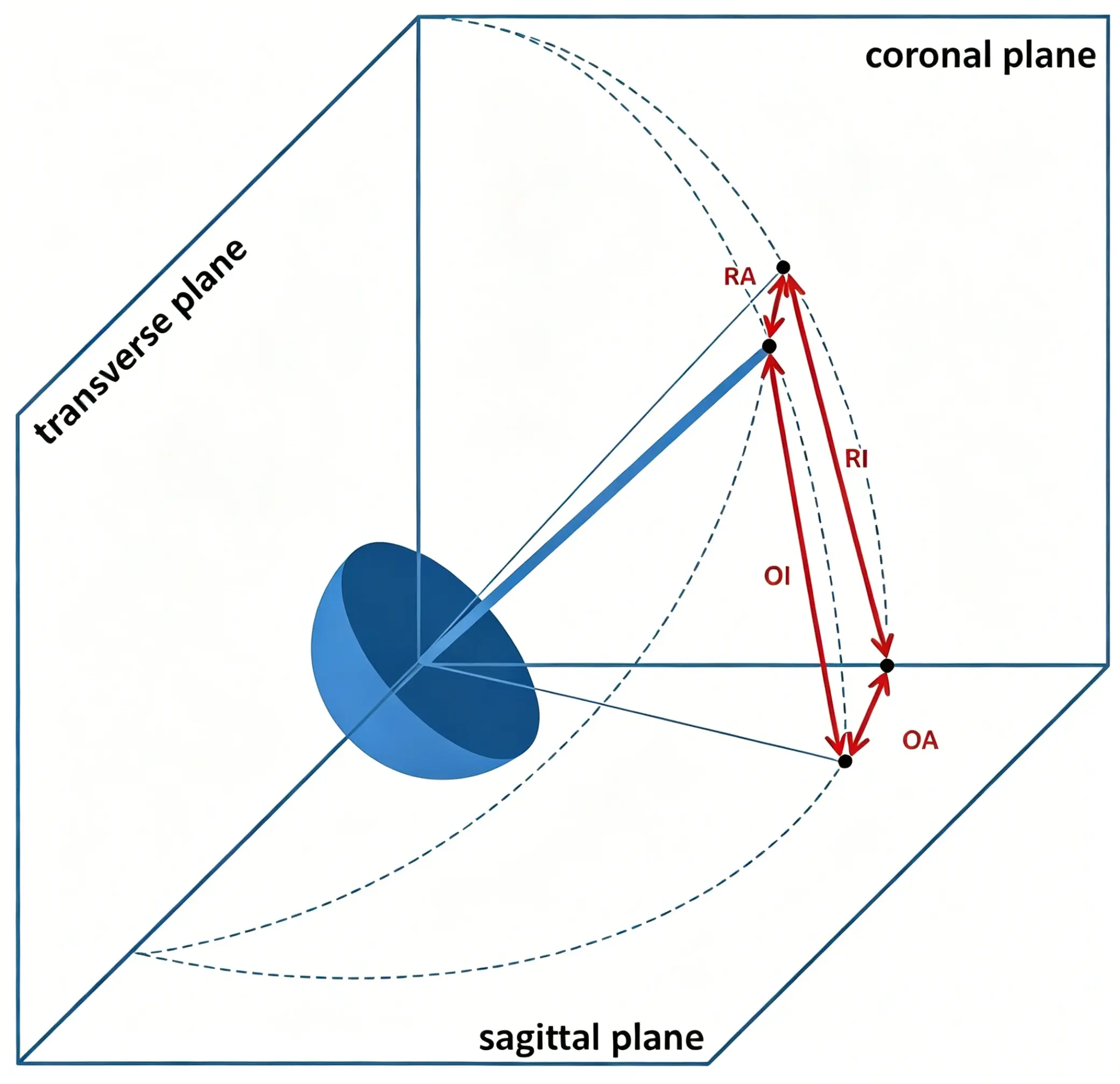 Three-dimensional model of acetabular cup.webp