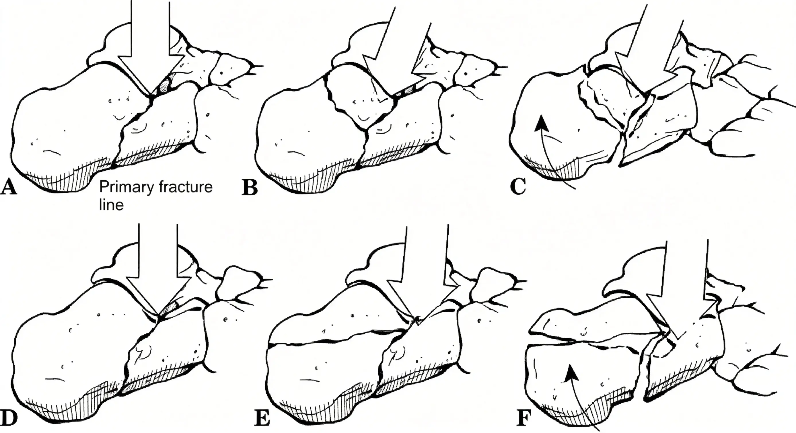 joint collapse.webp