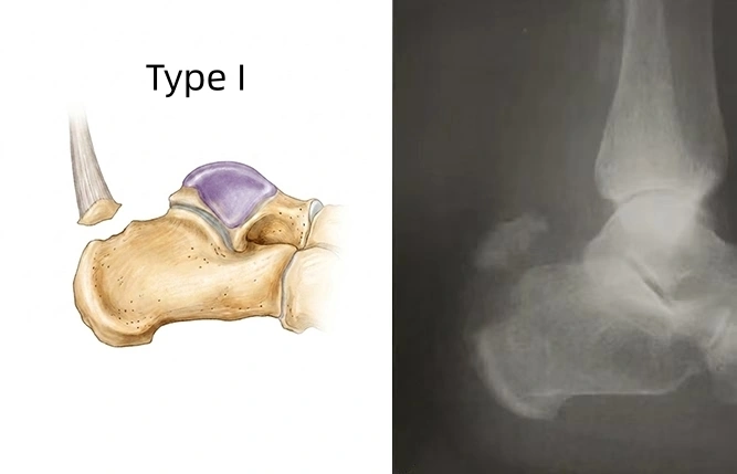 Type I.webp