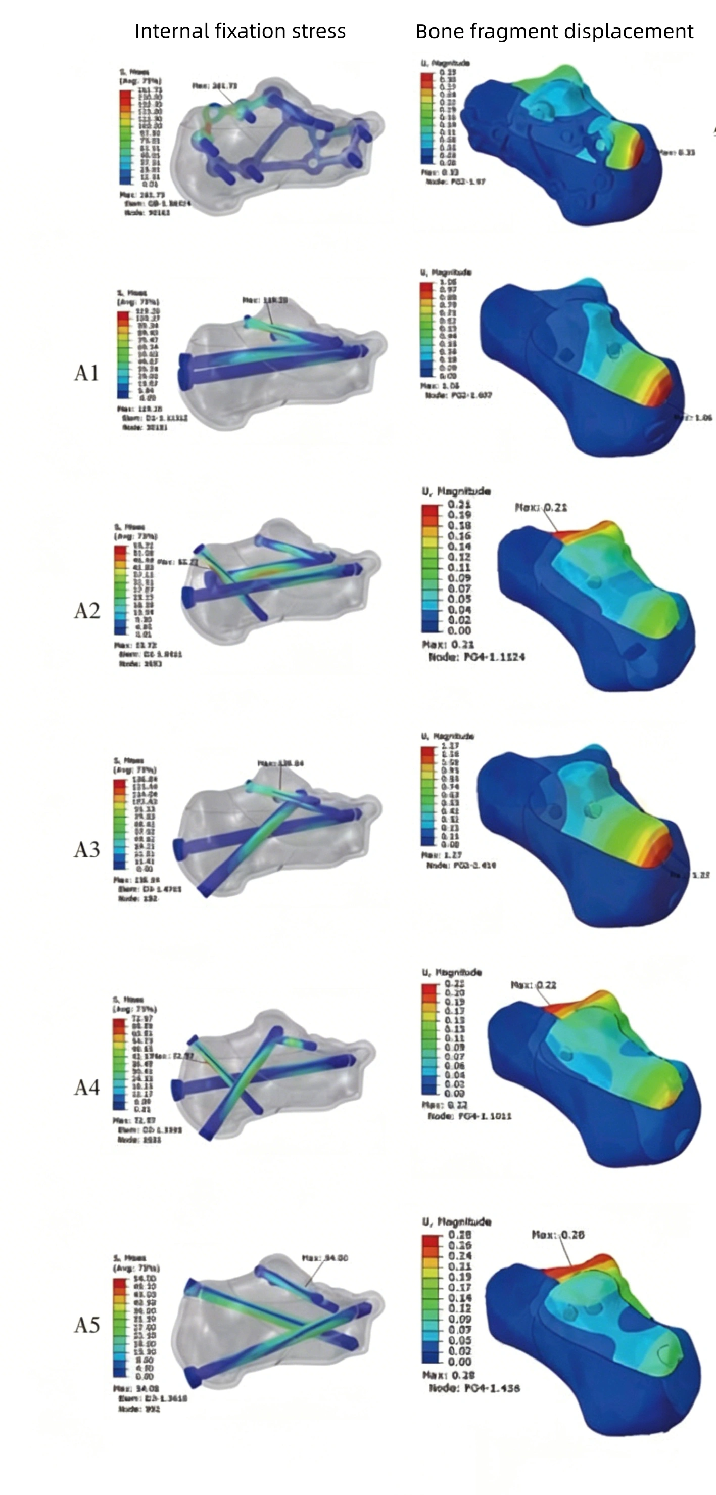 Tongue-type fracture model 3.webp
