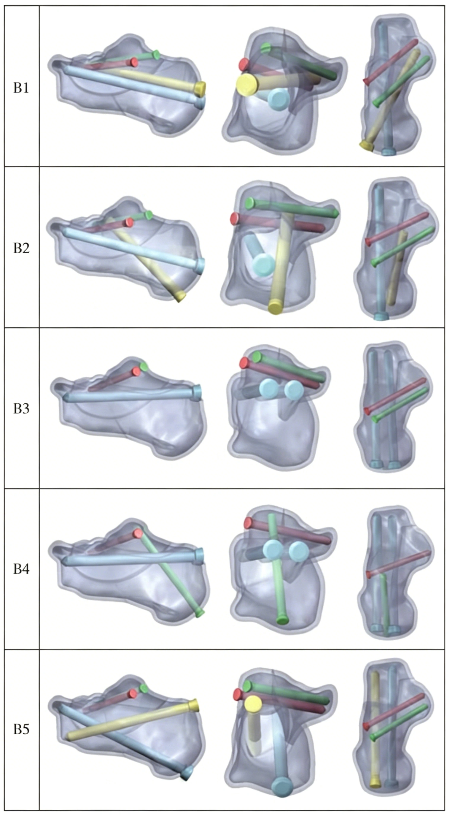 Tongue-type fracture model (3).webp
