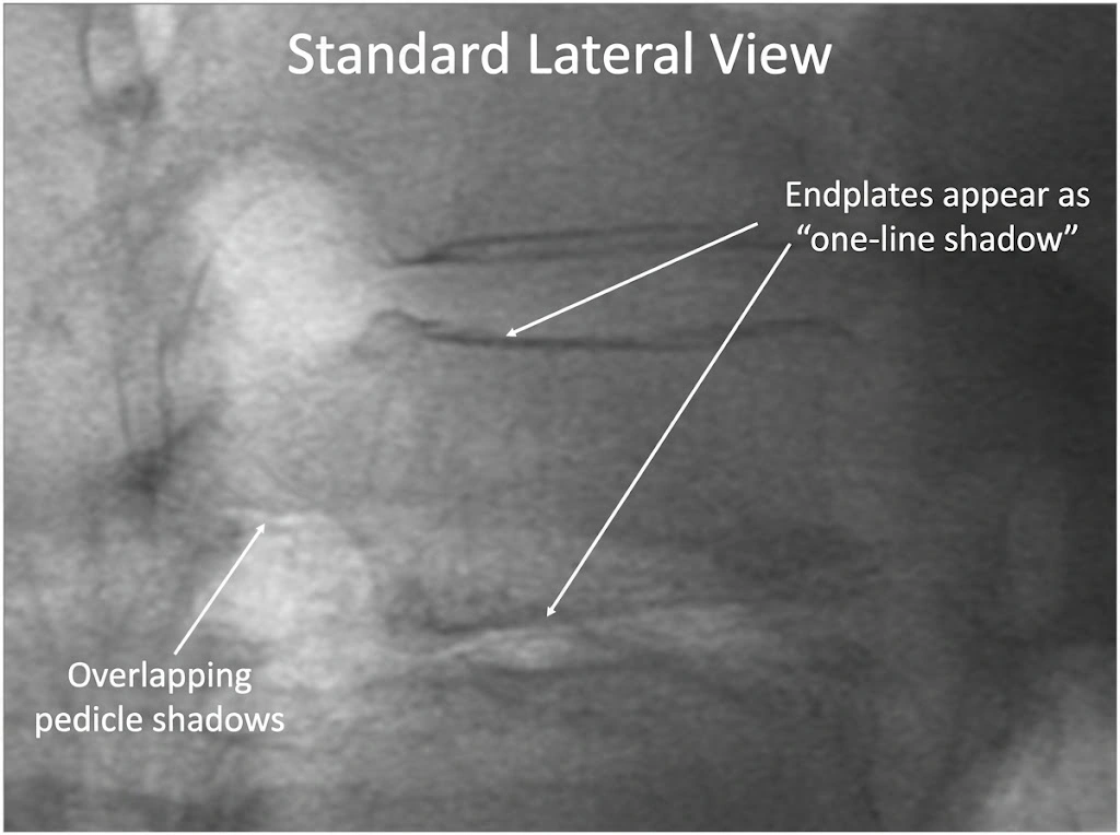 Fluoroscopic localization 2