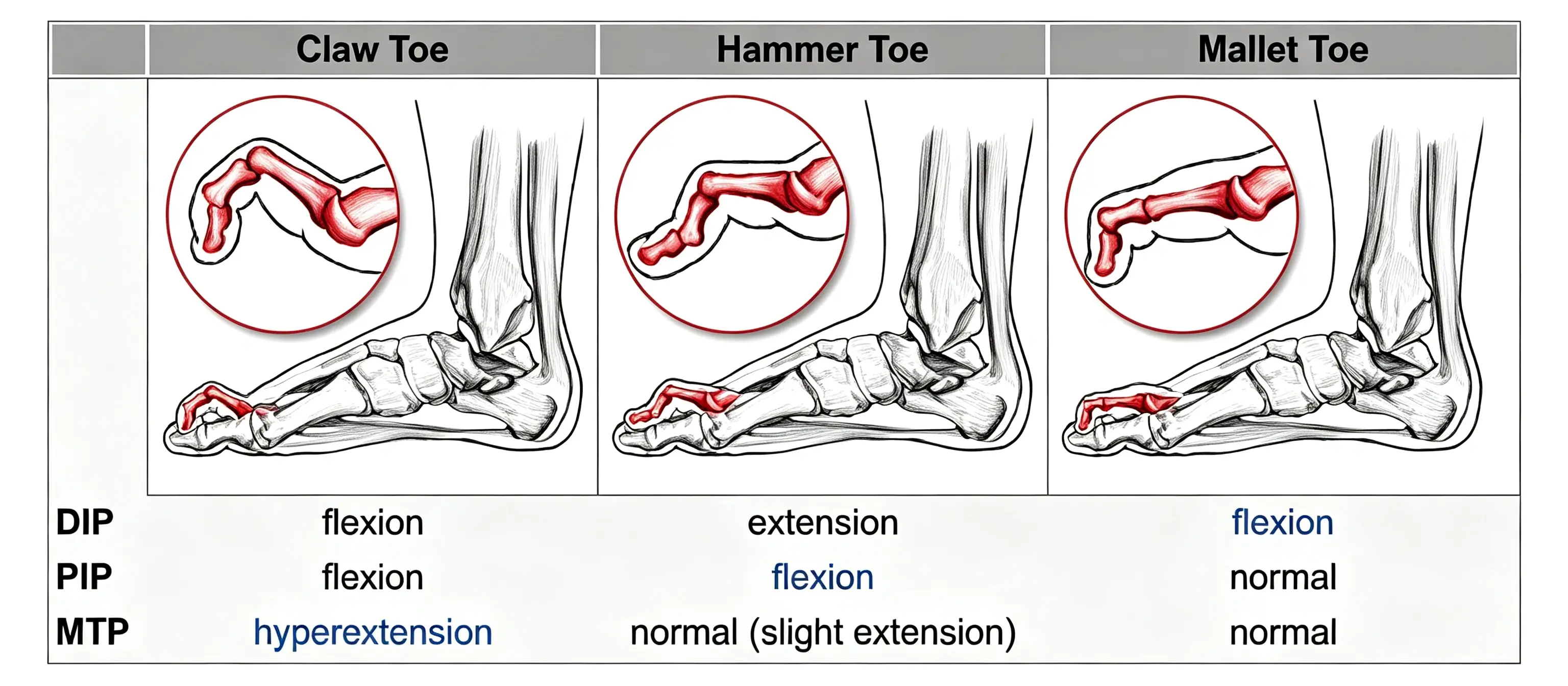 hammertoe(3)