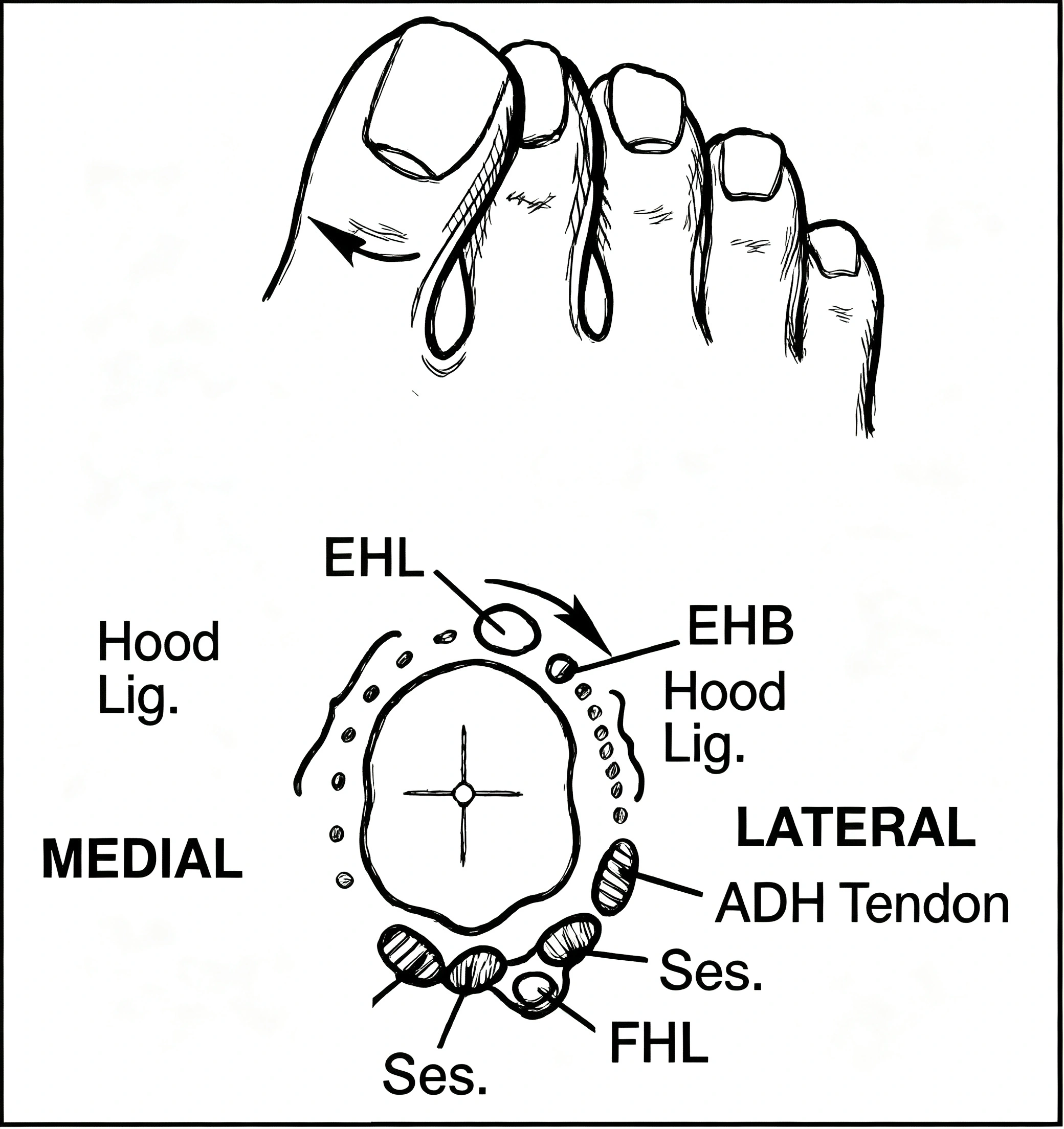 Hallux Valgus