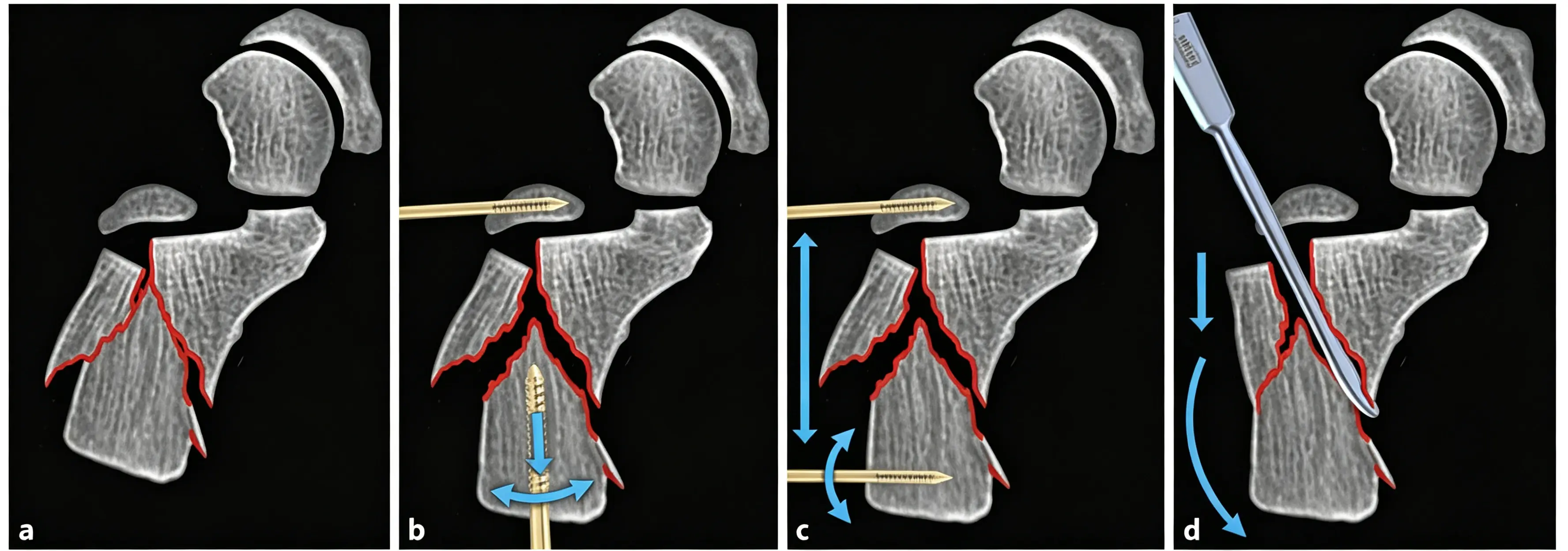 Technique for retraction and reduction of the calcaneal tuberosity bone fragment (1) (1)