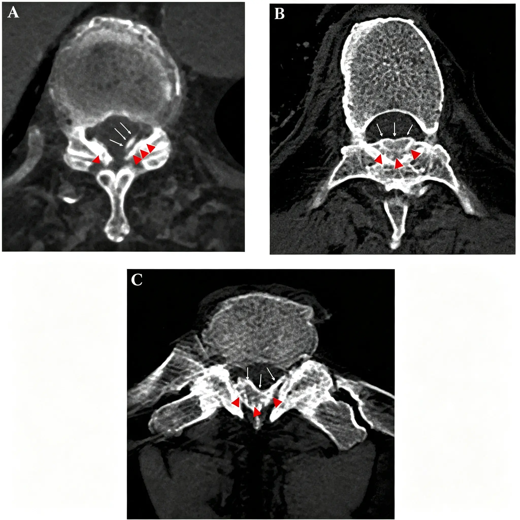 Signs of dural ossification (DO).webp