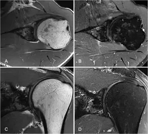 Left shoulder MRI examination.webp