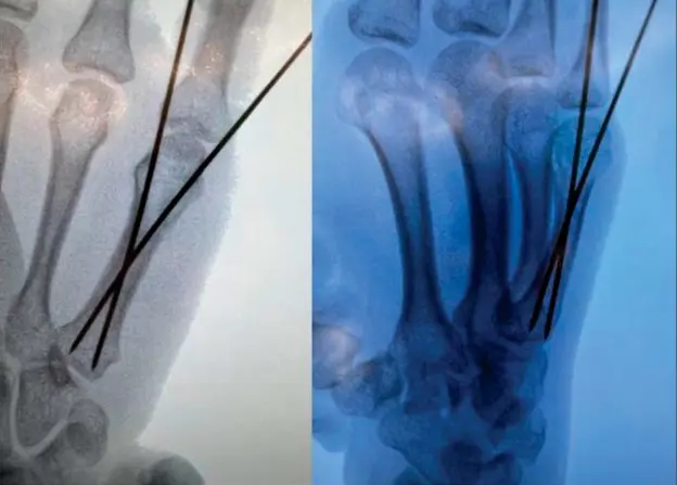 Percutaneous K-Wire Fixation2 (1).webp