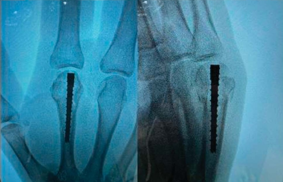 Intramedullary Screw Fixation 3.png