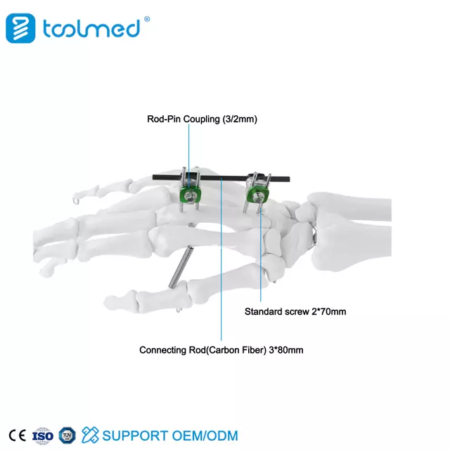 Finger & Palm External Fixator