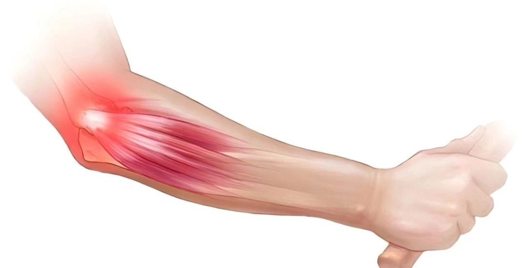 Tennis Elbow.webp