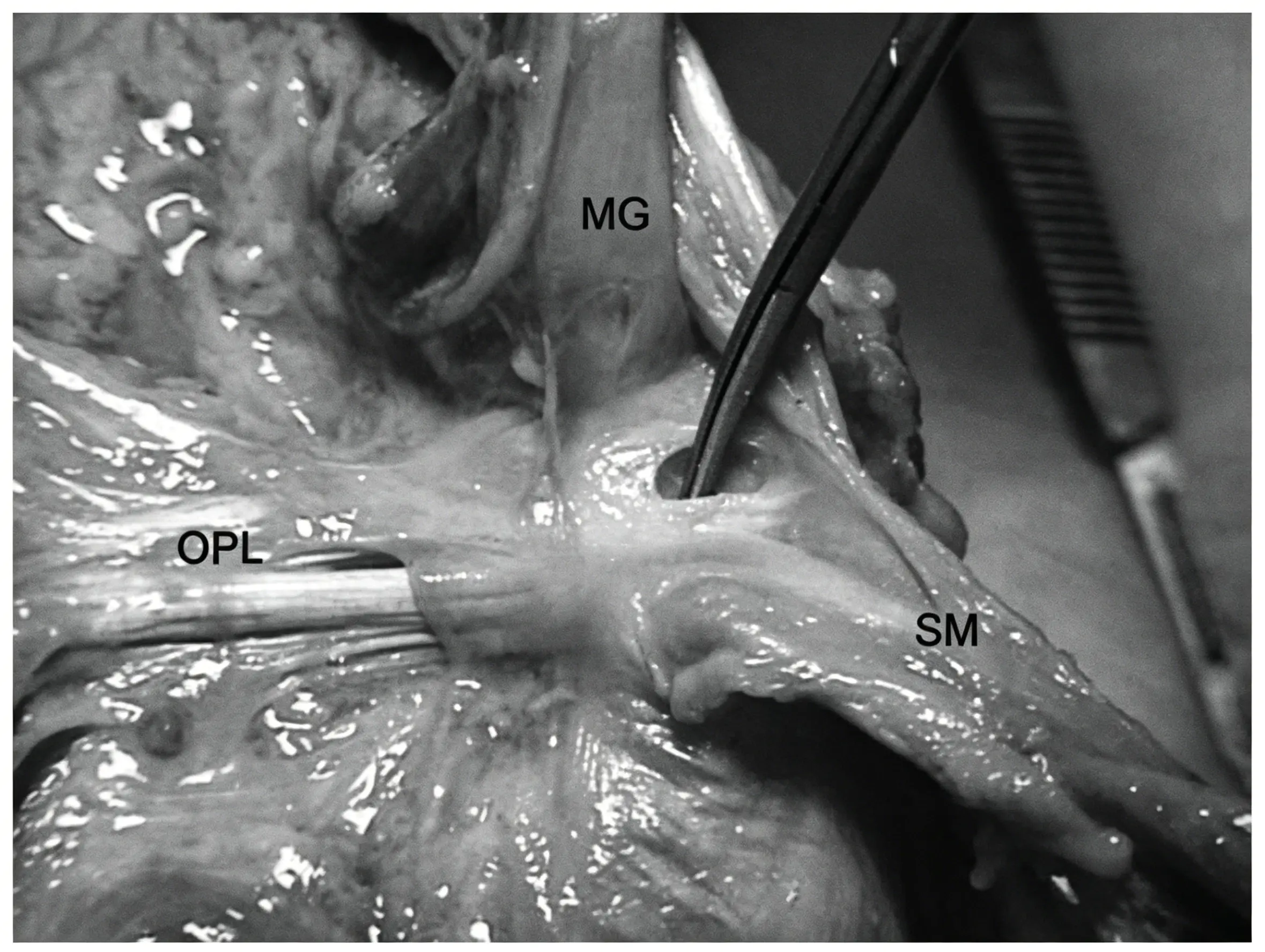 Figure 2. Posterior view of the left knee joint..webp