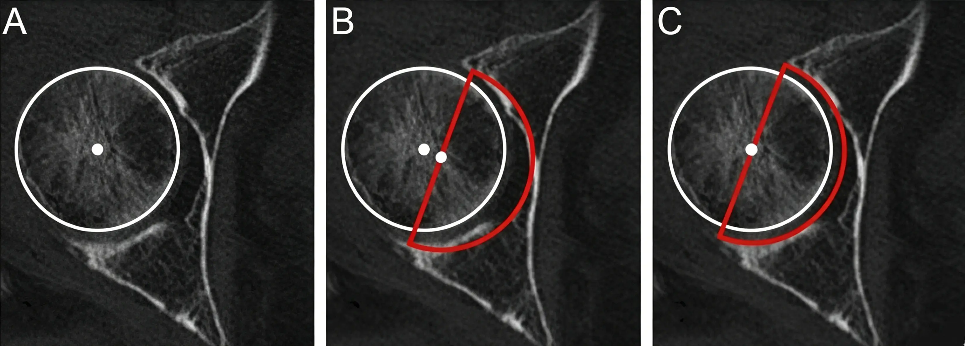 femoral head center.webp