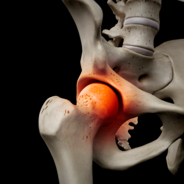 Osteonecrosis of the femoral head.png